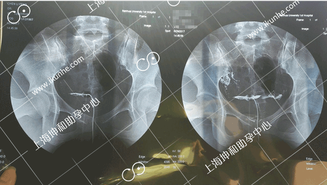 弱精试管婴儿坤和一次好孕