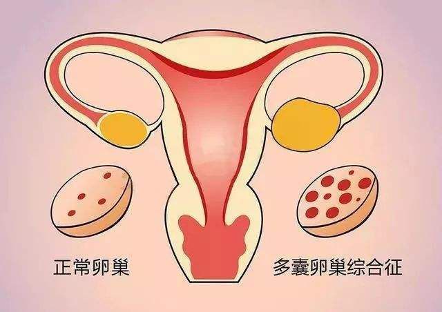 多囊卵巢综合症做试管成功案例